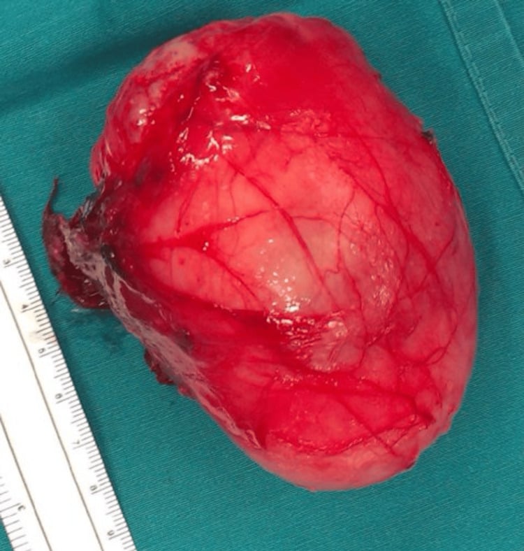 Gross specimen of an excised intramuscular myxoma from the arm.