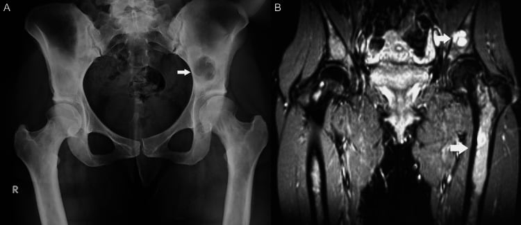 Pelvic radiograph and coronal STIR MRI showing polyostotic fibrous dysplasia in Mazabraud syndrome.