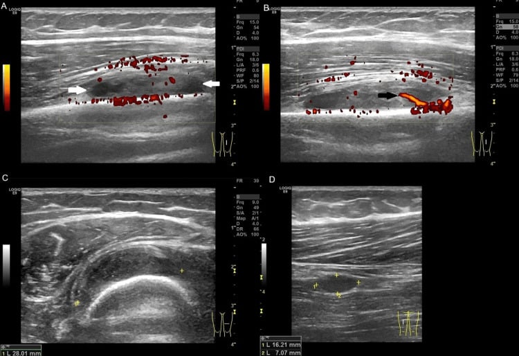 Greyscale and colour Doppler ultrasound of an intramuscular myxoma in Mazabraud syndrome.