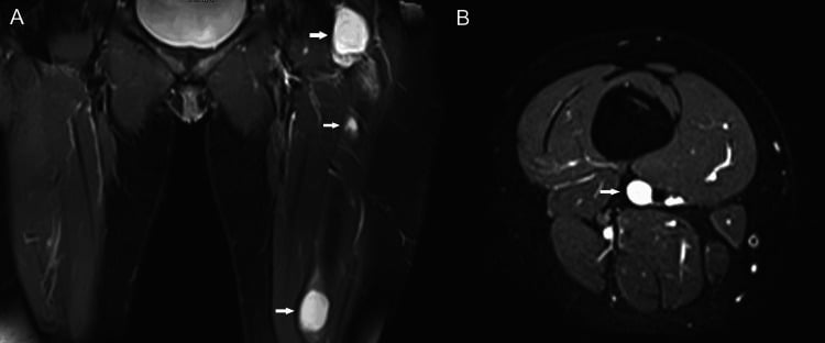 Coronal and axial STIR MRI showing multiple left-thigh intramuscular myxomas in Mazabraud syndrome.