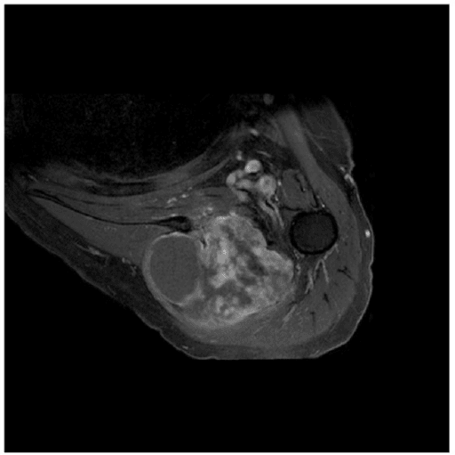 Post-contrast axial MRI of an intramuscular myxoma showing heterogeneous internal enhancement.