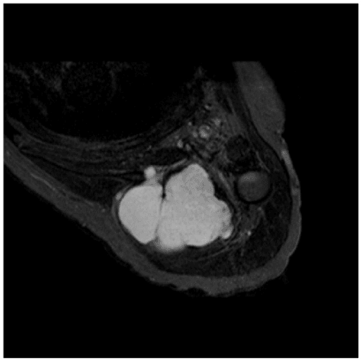 Axial fluid-sensitive MRI showing a large bright intramuscular myxoma in the deltoid region.