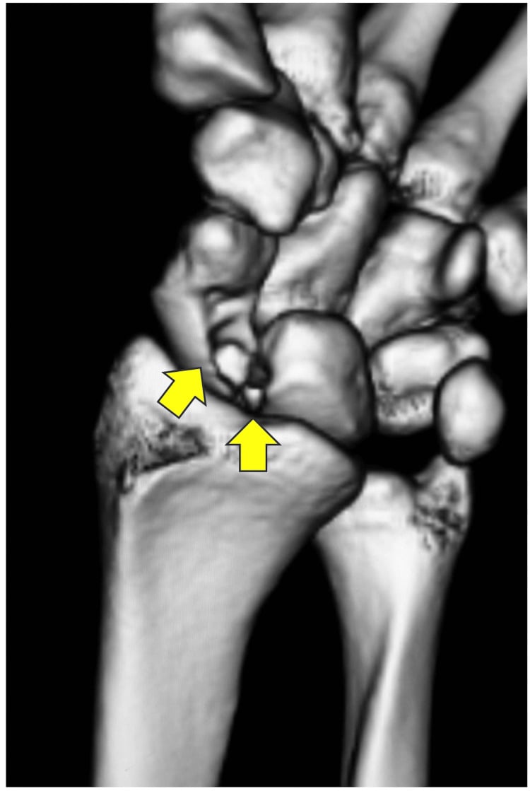 Preoperative 3D CT reconstruction demonstrating cortical entry perforation