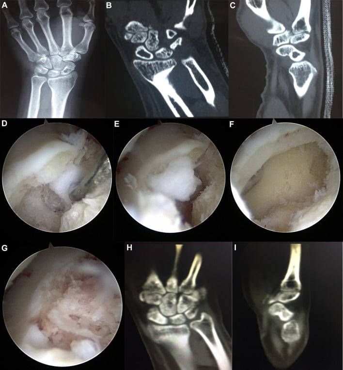 Preoperative radiograph, CT, and wrist arthroscopy of carpal intraosseous ganglion