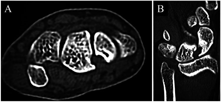 Follow-up CT at 2 years post-curettage demonstrating bone void consolidation