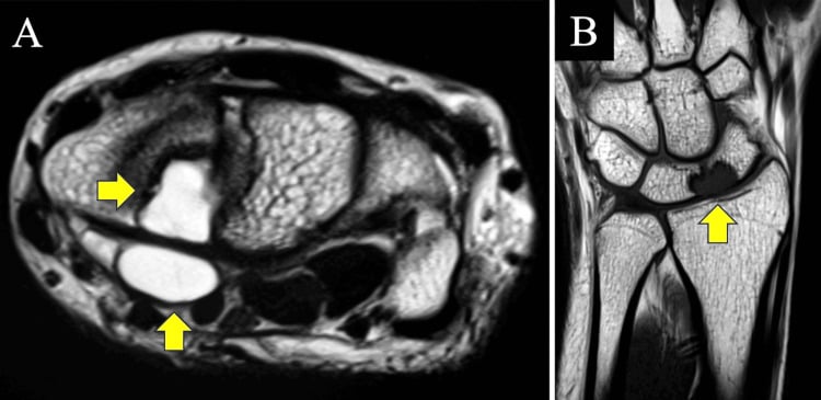 Axial T2 and coronal T1 MRI showing an intraosseous ganglion as a fluid-signal lesion in the carpal bones