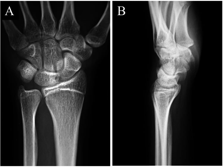 Posteroanterior and lateral wrist radiographs used to assess an intraosseous ganglion spanning the scaphoid and lunate