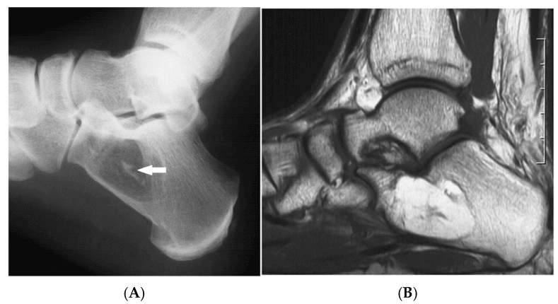 Lateral calcaneal radiograph (A) with an arrow on a central calcification inside a lucent lesion, and sagittal MRI (B) with a bright lesion in the calcaneal body
