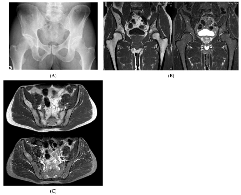 Pelvic radiograph (A) with paired coronal (B) and axial (C) MRI of a right iliac lesion, each pair with one sequence showing fat bright and one showing it suppressed