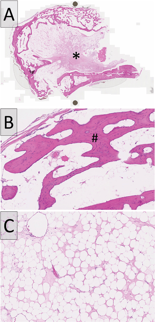 Three-panel histology: (A) low-power section of a nodule within a rim of bone, asterisk at its centre; (B) bony trabeculae marked # with fat between them; (C) sheets of mature adipocytes