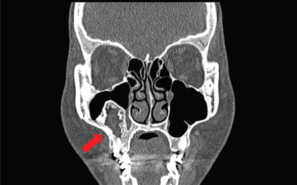 Coronal CT of the face with a red arrow marking a lesion in the floor of the right maxillary sinus