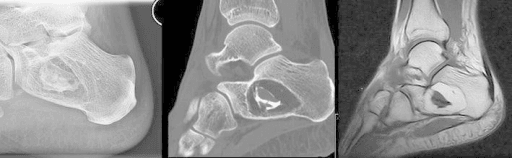 Multimodality imaging demonstrating diagnostic features of calcaneal lipoma