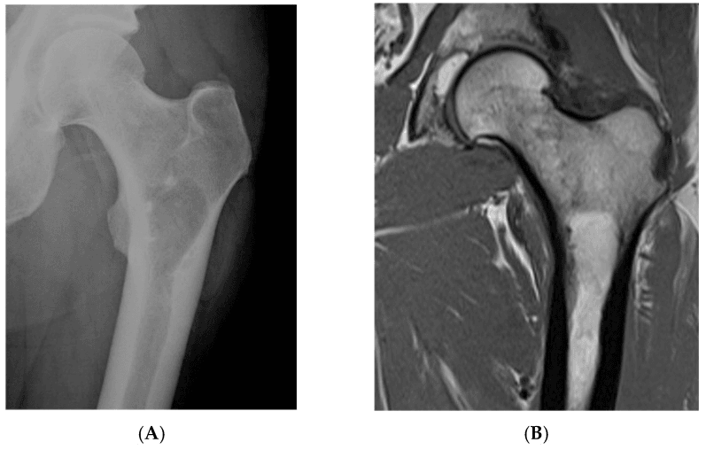 Radiograph (A) and coronal MRI (B) of the proximal femur with a lucent area in the intertrochanteric region