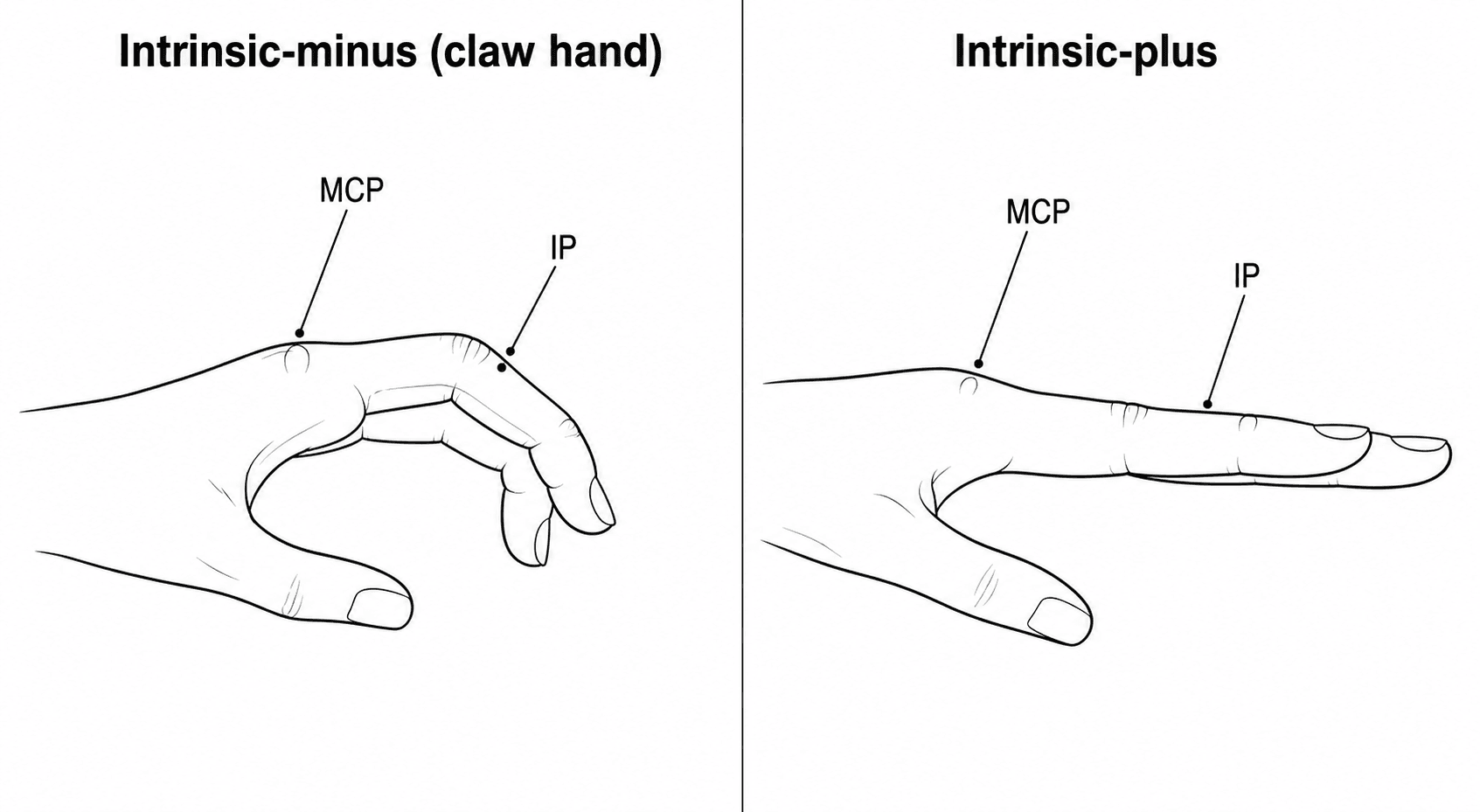 Side-by-side diagram of intrinsic-minus claw hand (MCP hyperextended, IP flexed) and intrinsic-plus (MCP flexed, IP extended)