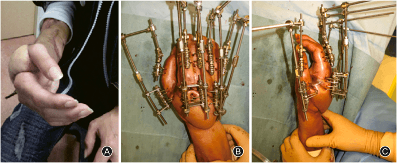 Post-traumatic hand contracture resembling an intrinsic-plus posture