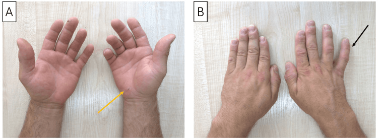 Wartenberg sign and impaired finger adduction after deep ulnar injury