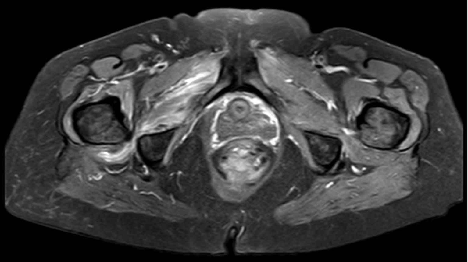 Axial fat-saturated pelvic MRI showing quadratus femoris oedema in a narrowed ischiofemoral space.
