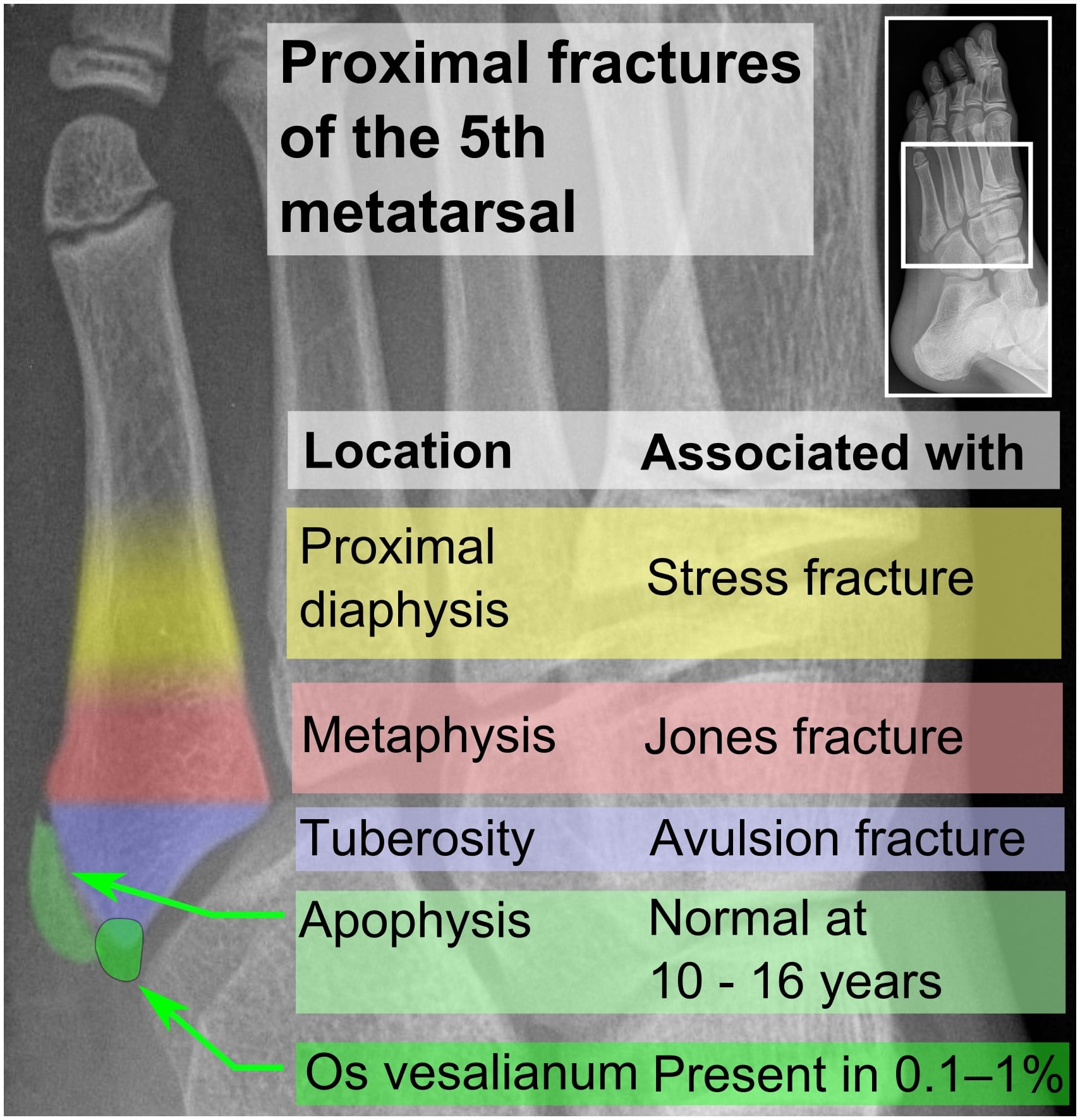 Annotated lateral foot radiograph mapping the zones of the proximal fifth metatarsal: stress fracture, Jones fracture, avulsion fracture, apophysis and os vesalianum.