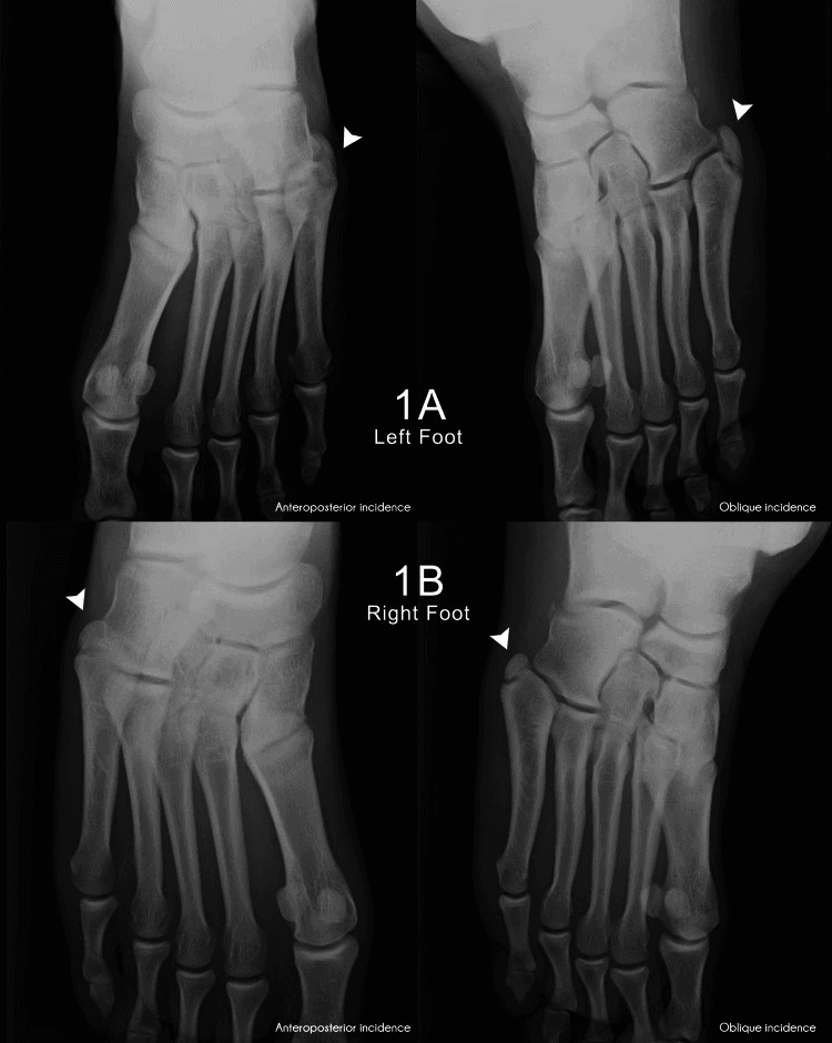 Bilateral anteroposterior and oblique foot radiographs showing os vesalianum on both sides