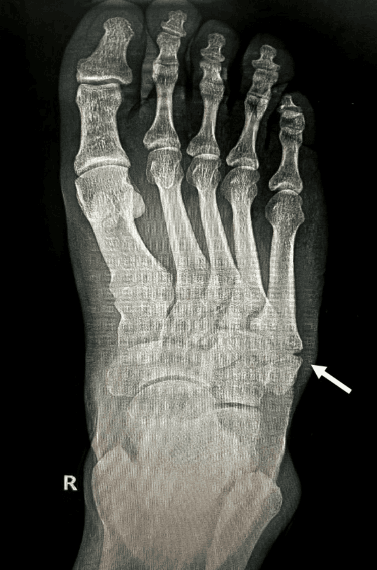 Oblique foot radiograph showing an acute fracture through the fifth metatarsal base after twisting injury