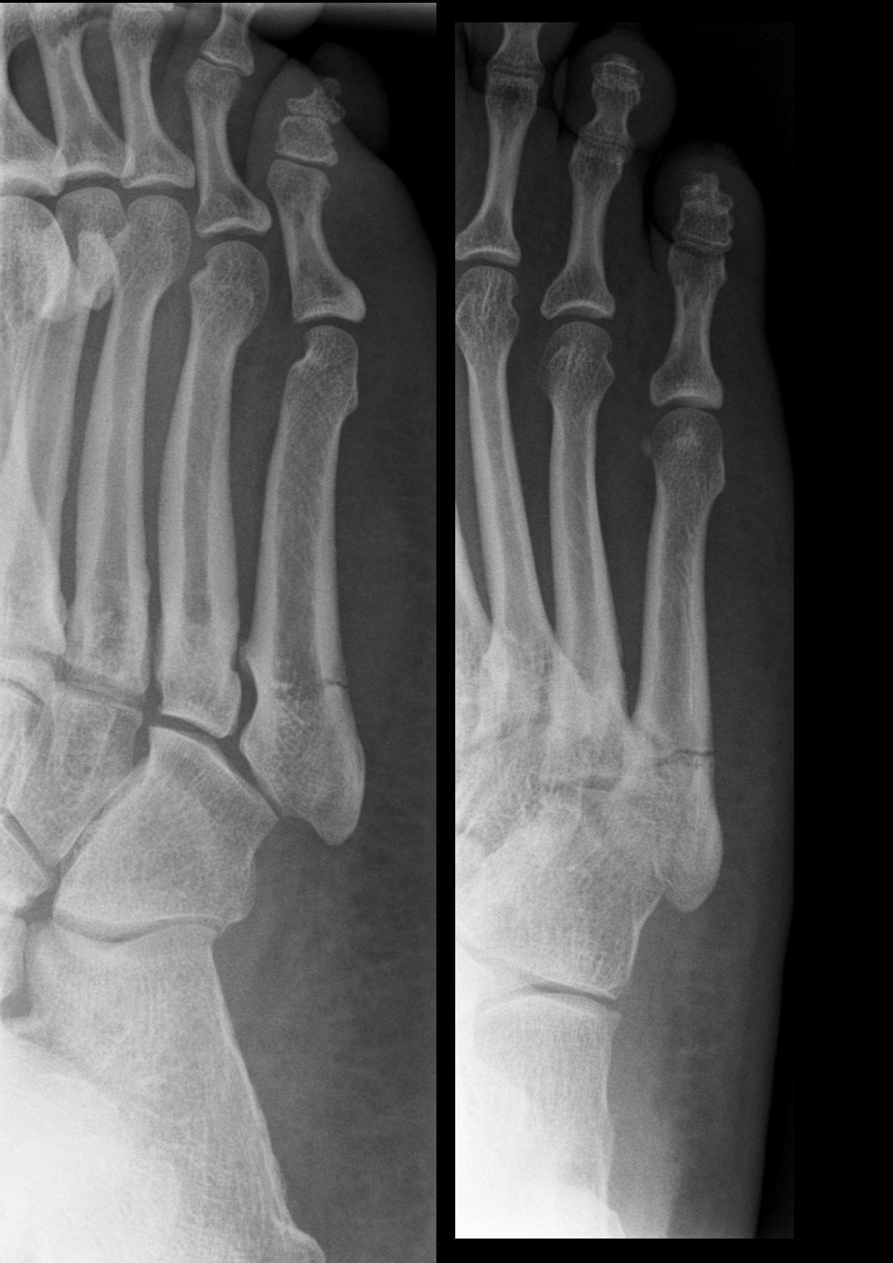 Oblique and anteroposterior foot radiographs showing a transverse fracture at the metaphyseal-diaphyseal junction of the proximal fifth metatarsal.