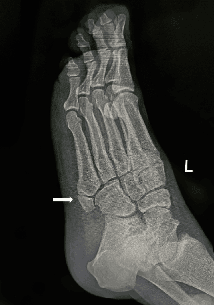 Left foot radiograph showing matching os vesalianum at the fifth metatarsal base