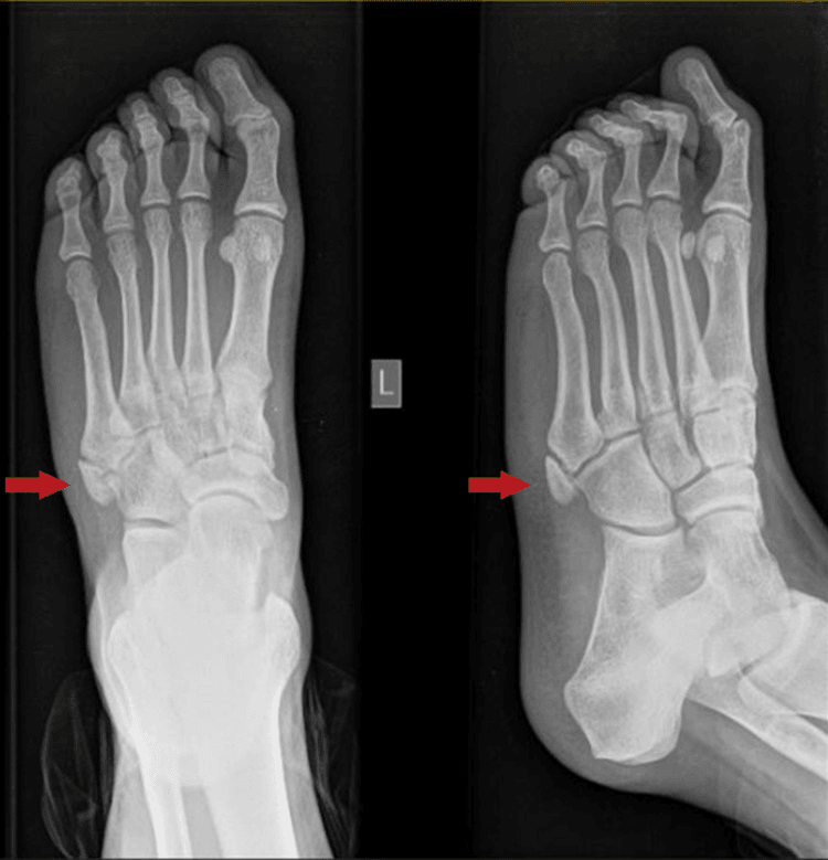 Anteroposterior and oblique foot radiographs showing os vesalianum articulating with the cuboid and fifth metatarsal base