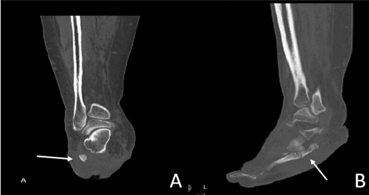 Coronal and sagittal CT showing an accessory ossicle connected to the fifth metatarsal base