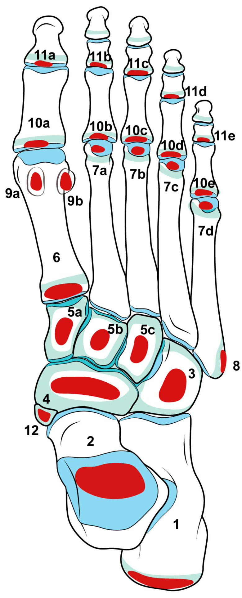 Diagram mapping paediatric osteochondroses across the foot including the fifth metatarsal base apophysis