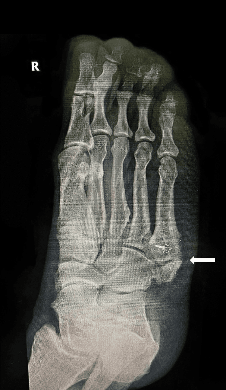 Right foot radiograph showing os vesalianum at the fifth metatarsal base