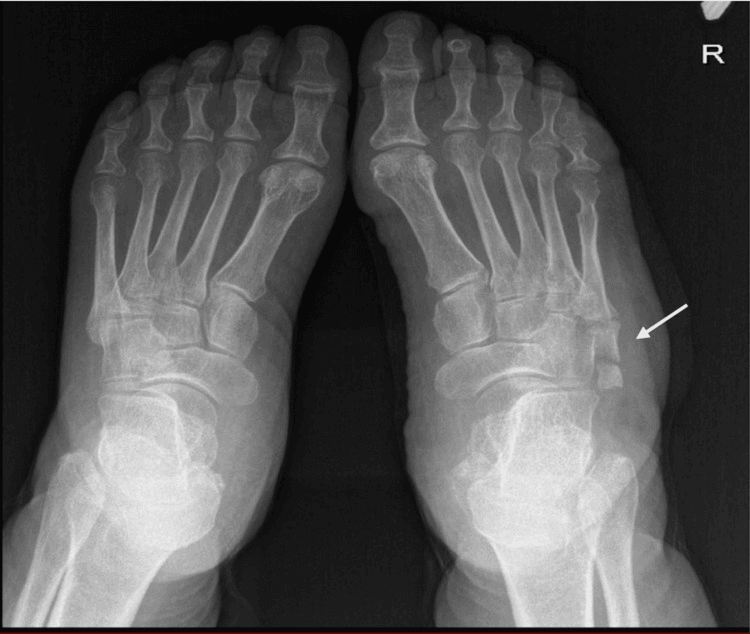 Bilateral foot radiograph showing a unilateral accessory ossicle at the right fifth metatarsal base