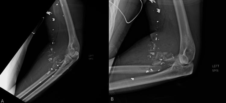 Two radiographs (A, B) of the left elbow and proximal forearm showing a comminuted proximal radial shaft fracture surrounded by ballistic fragments