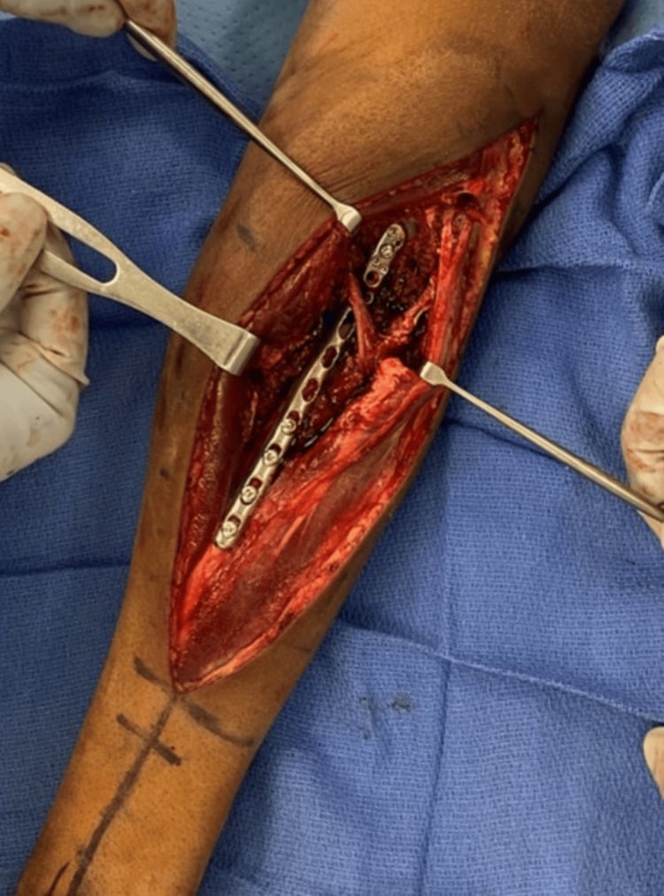 Plate fixation of a comminuted proximal radial shaft fracture