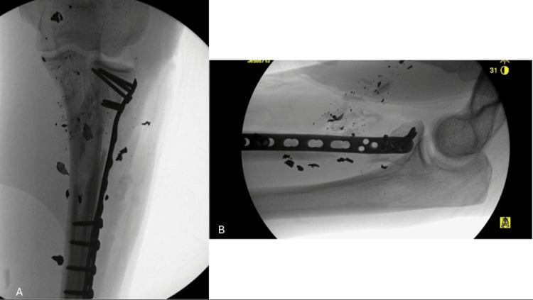 Immediate AP and lateral fluoroscopy after proximal radial shaft fixation