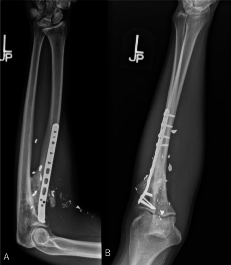 Twenty-four-month radiographs of a united proximal radial shaft fracture