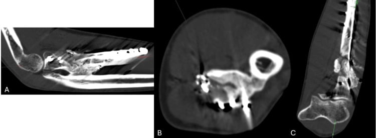CT assessment for heterotopic ossification and proximal radioulnar synostosis