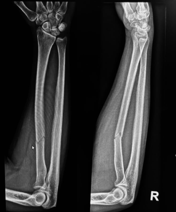 AP and lateral radiographs of an isolated proximal radial shaft fracture