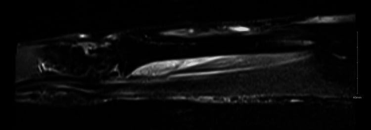 MRI showing flexor pollicis longus oedema after proximal radius ORIF