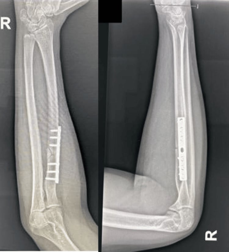 Postoperative radiographs after proximal radial shaft plating