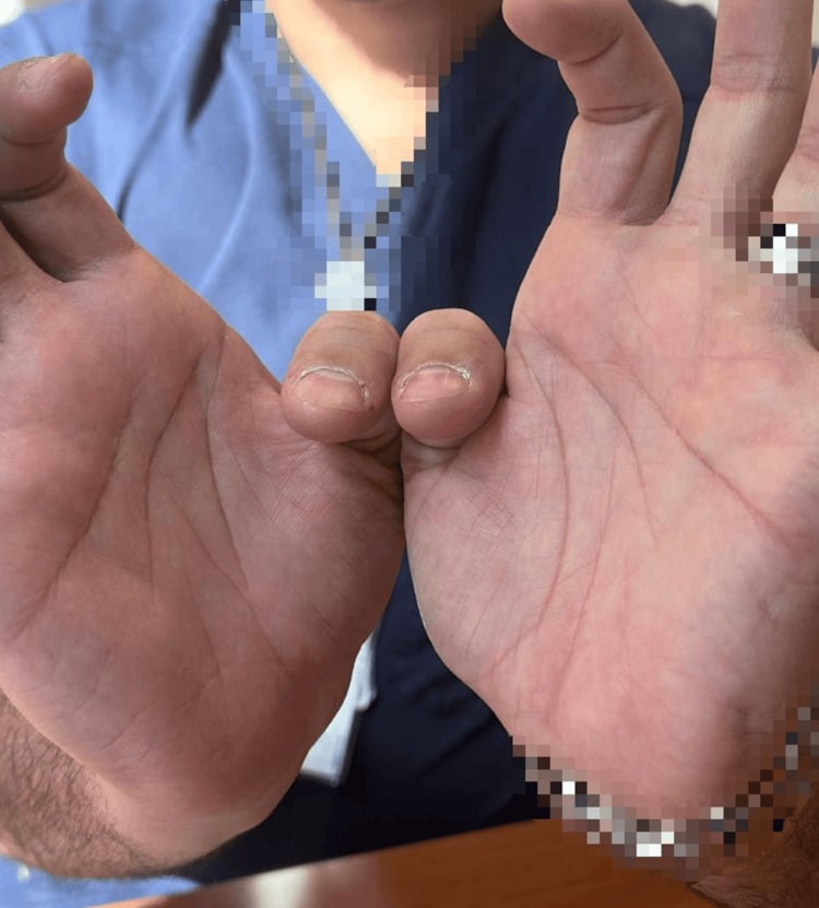 Recovery of thumb interphalangeal flexion after postoperative AIN-pattern weakness