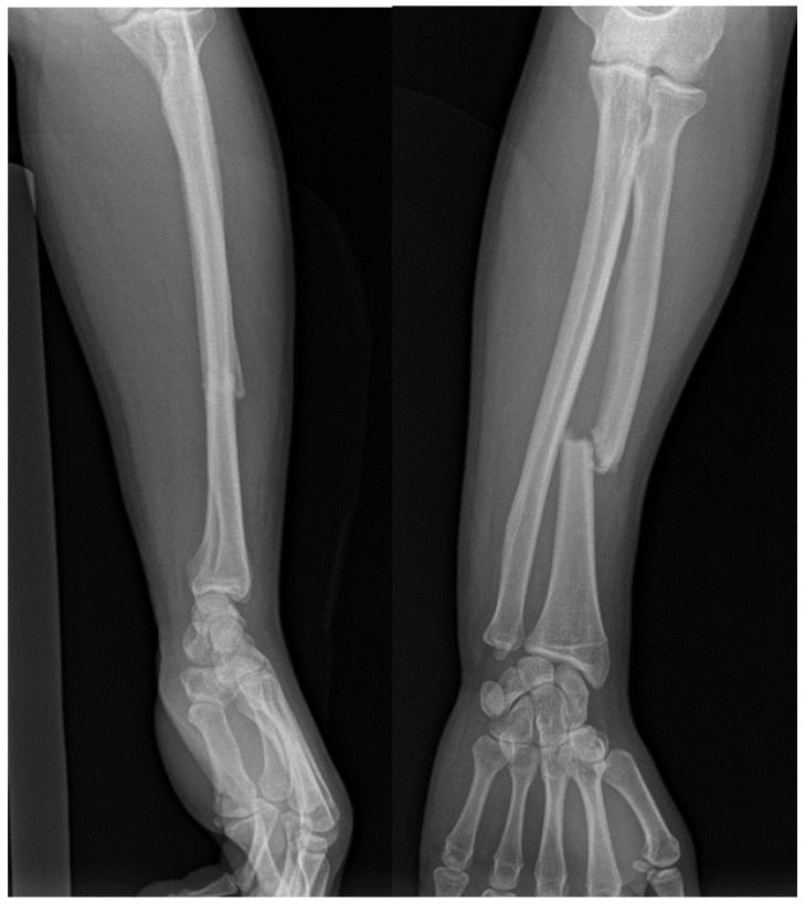 AP and lateral radiographs of a Galeazzi fracture-dislocation