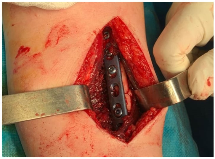 Volar Henry exposure and plate fixation of the radial shaft