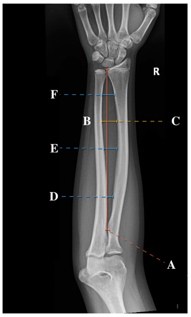 Forearm radiograph annotated with lettered lines A to F for radial-bow measurement