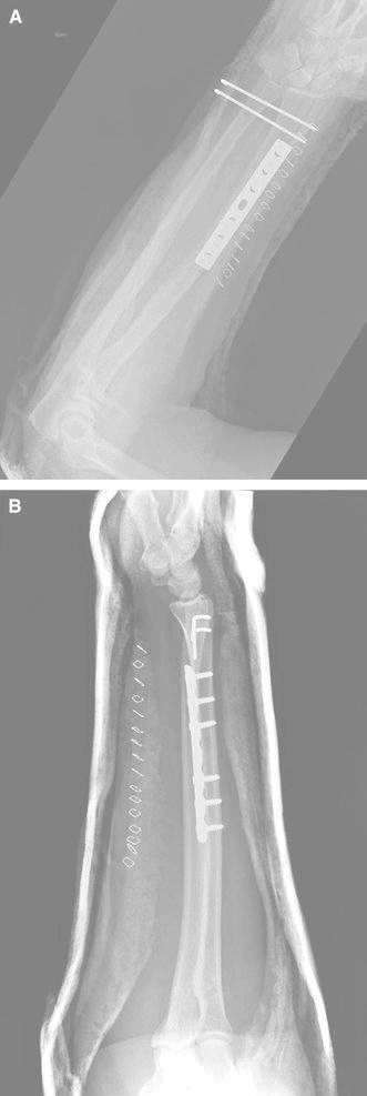 Isolated radius shaft fracture treated with ORIF plate fixation