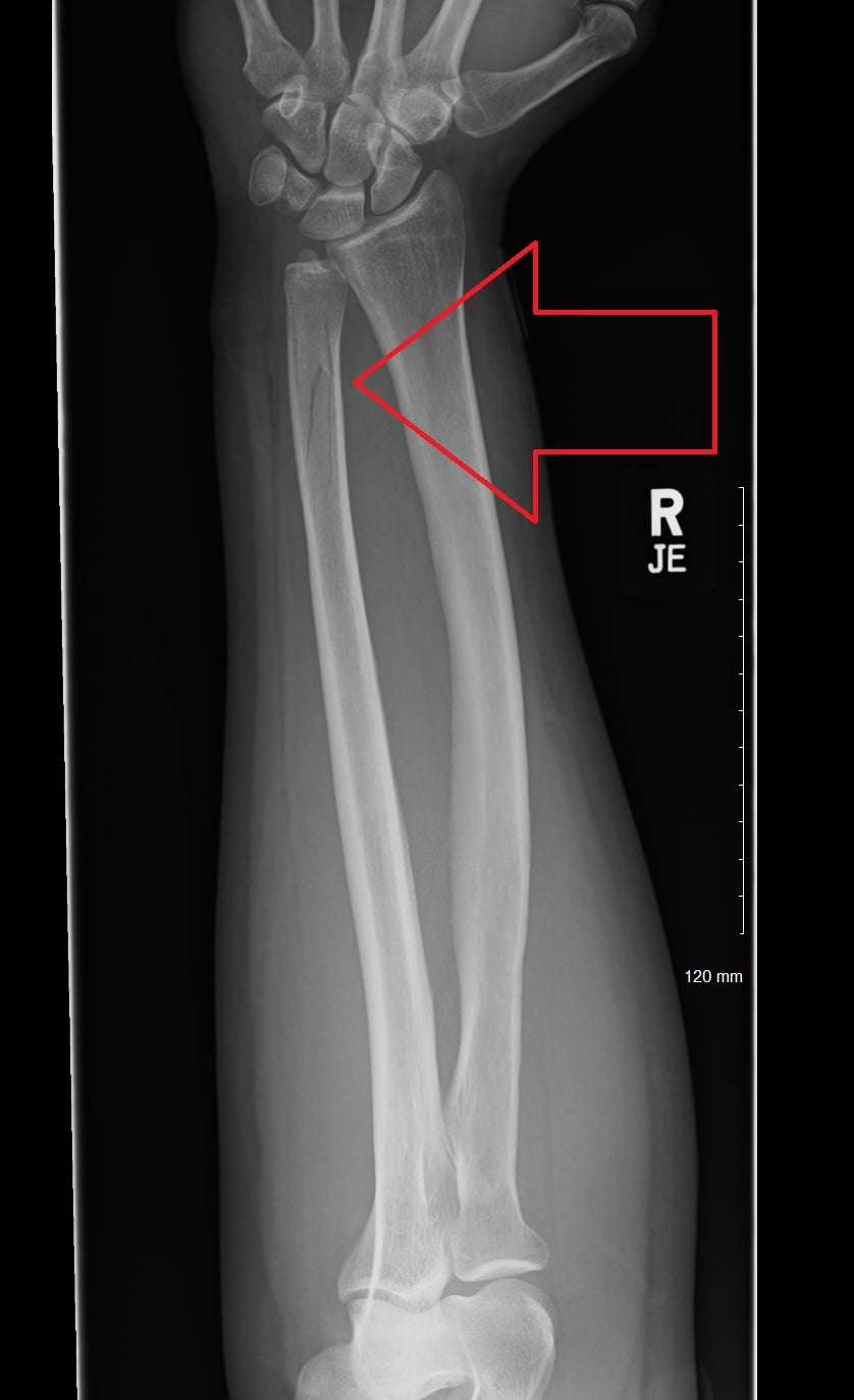 AP forearm radiograph showing an isolated fracture of the ulnar shaft with an intact radius, a nightstick fracture.