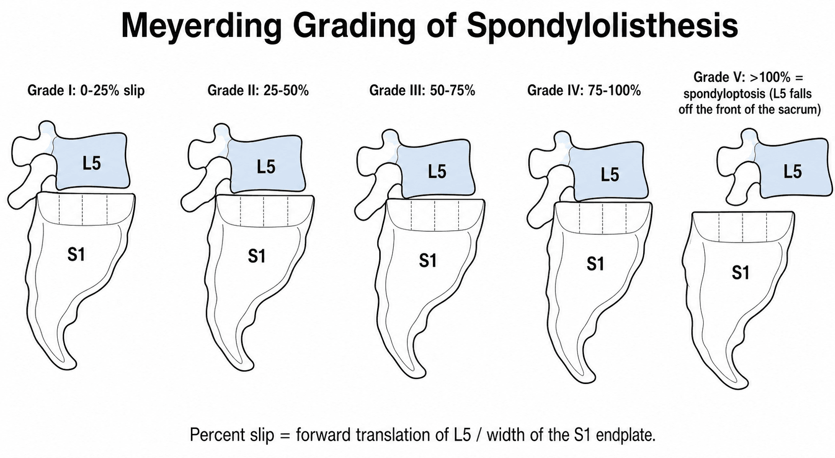 Diagram of the Meyerding grading of spondylolisthesis, showing L5 slipping progressively forward on S1 from grade I to grade V (spondyloptosis).