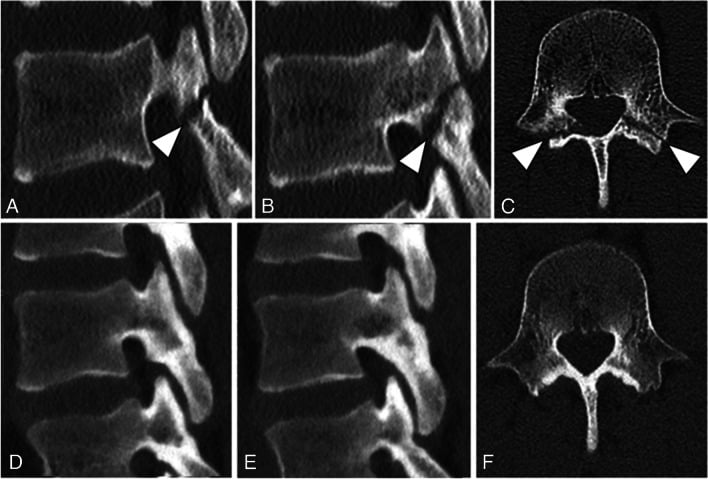 Sagittal CT images of both sides in a fifteen-year-old showing bilateral L4 spondylolysis with the defect arrowed