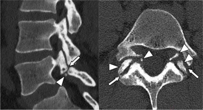 Follow-up sagittal and axial CT showing a persisting lysis gap on both sides with multiple ossicles within the gap in a twenty-three-year-old