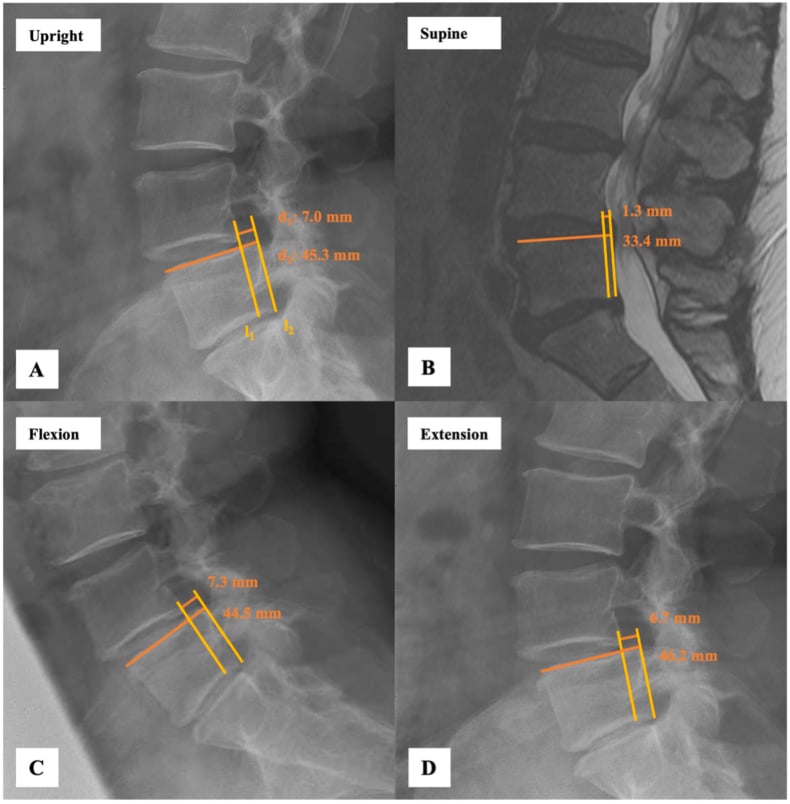 Upright, supine, flexion and extension lateral radiographs showing position-dependent variation in the degree of slip