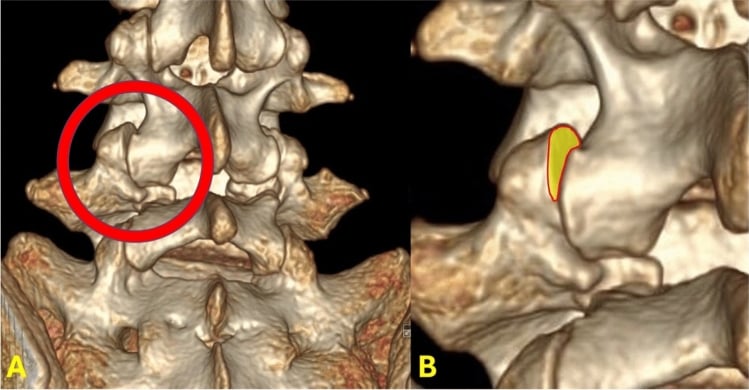Three-dimensional CT reconstruction showing the L4 inferior articular process subluxating below the L4-L5 facet joint